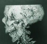 写真5　X線コンピュータ断層撮影によるミイラの主の頭蓋骨の復元像（側面図）