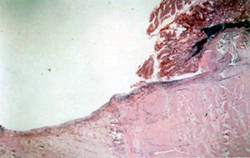 消化器官の潰瘍